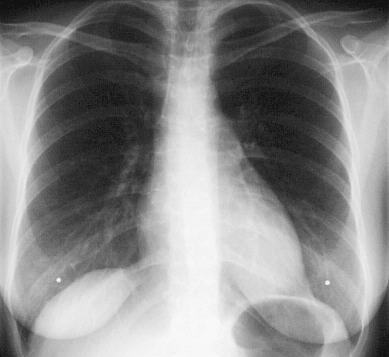 Beim Röntgen Einen Fleck Auf Der Lunge Entdeckt